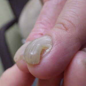 平塚市　巻き爪　手の爪