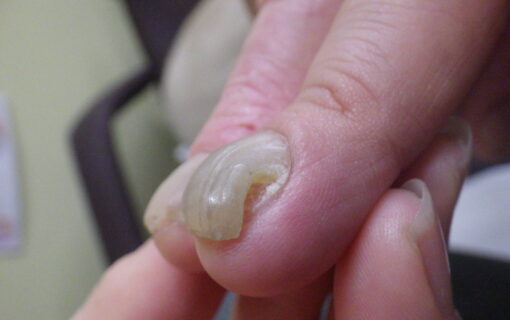 平塚市　巻き爪　手の爪