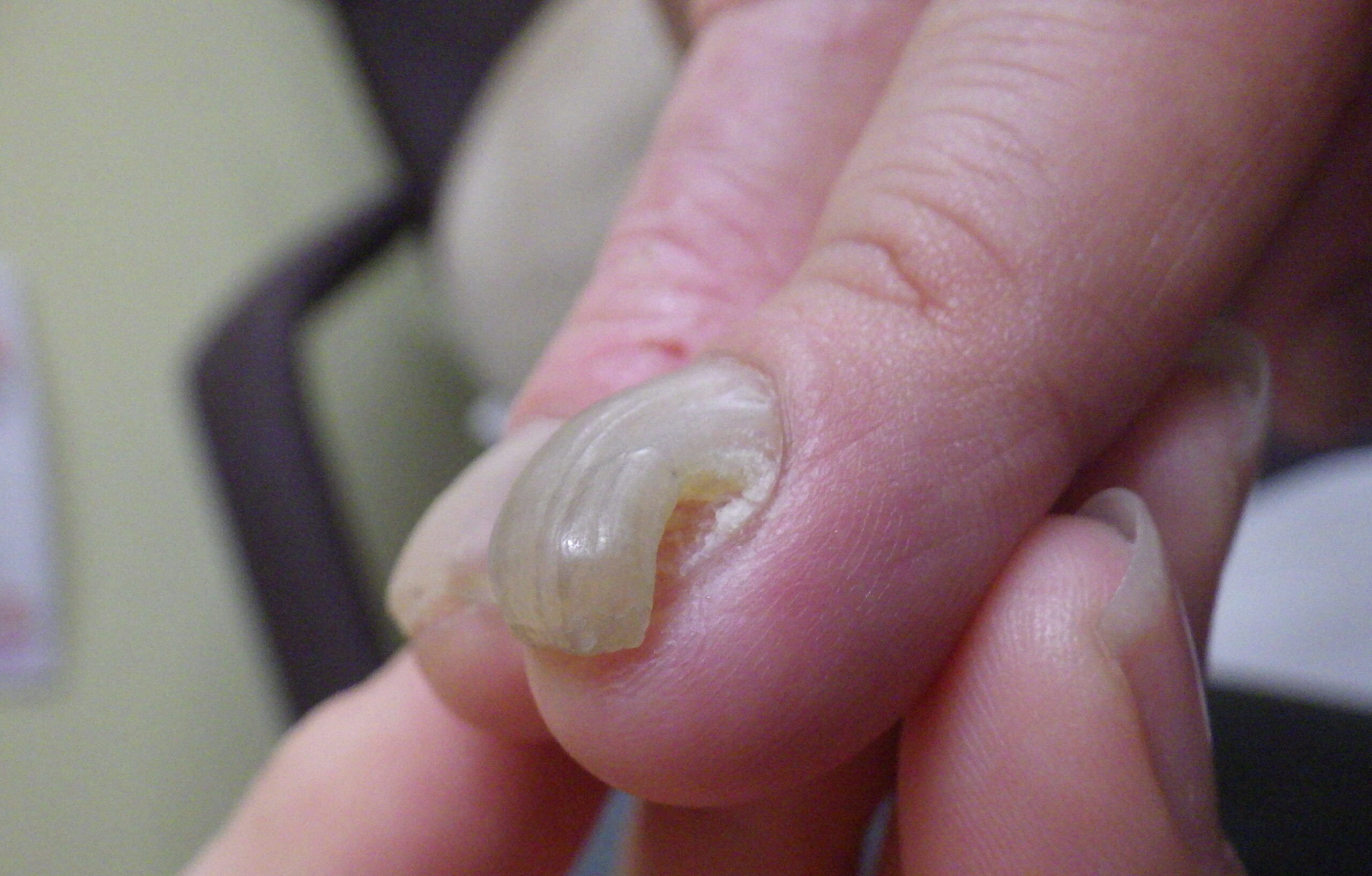 平塚市　巻き爪　手の爪