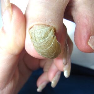 平塚市　巻き爪　変形爪