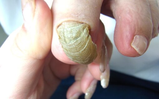 平塚市　巻き爪　変形爪