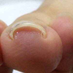 平塚市　巻き爪　ビフォー