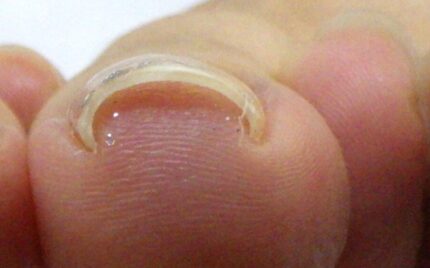 平塚市　巻き爪　ビフォー