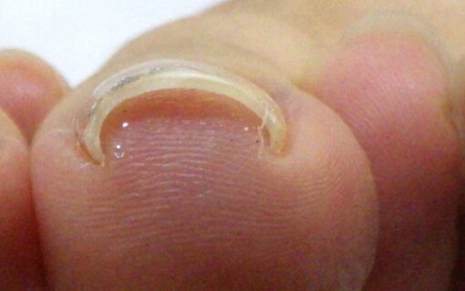 平塚市　巻き爪　ビフォー