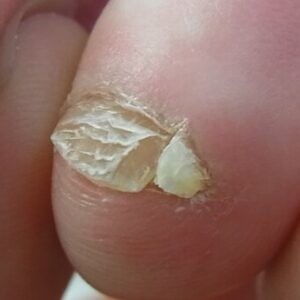 平塚市　巻き爪　副爪