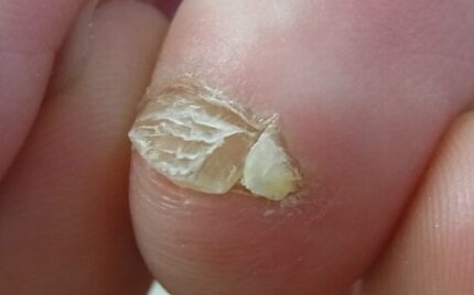 平塚市　巻き爪　副爪