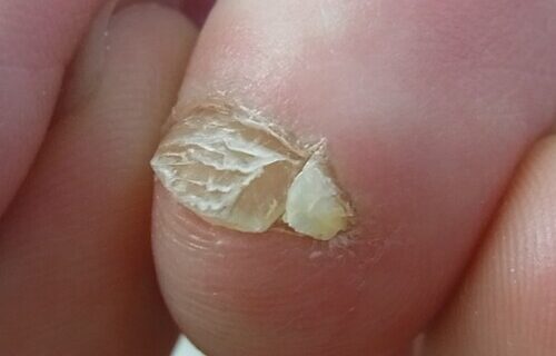 平塚市　巻き爪　副爪