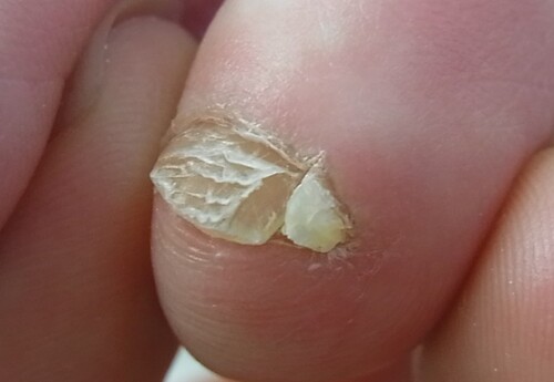 平塚市　巻き爪　副爪