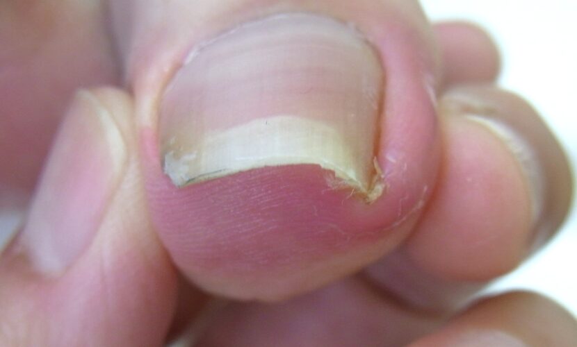 町田市　巻き爪　ビフォー