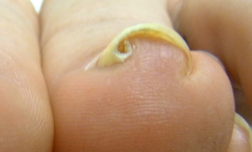 町田市　巻き爪　ビフォー