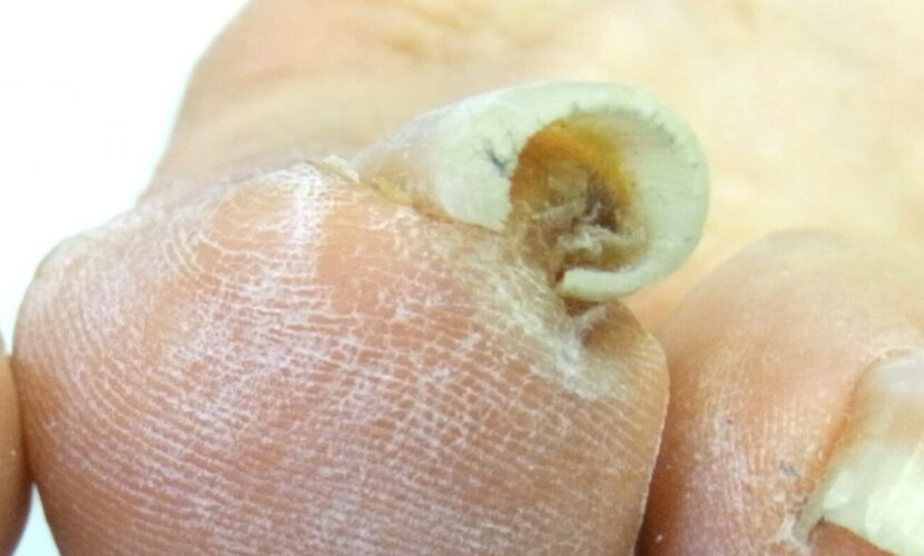 町田市　巻き爪　ビフォー