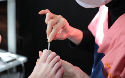 大船　巻き爪　施術