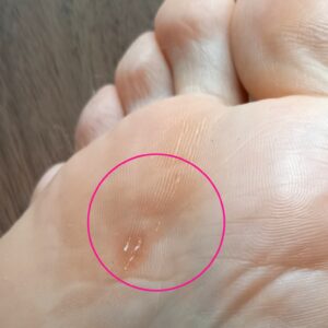 大船　巻き爪　タコ