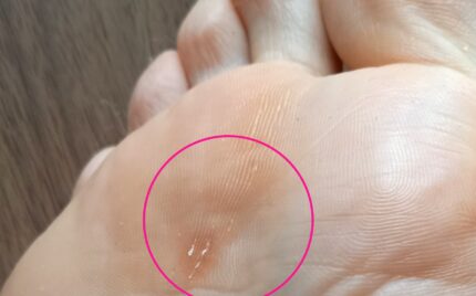 大船　巻き爪　タコ