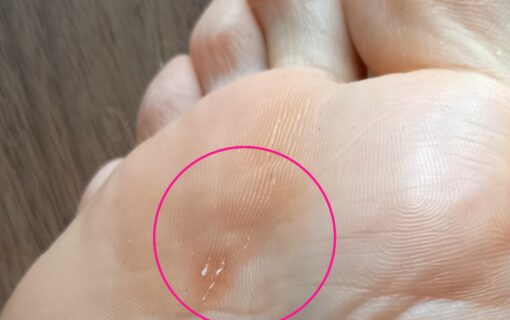 大船　巻き爪　タコ