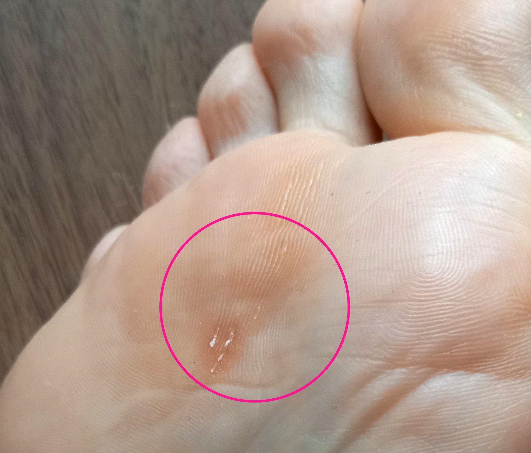 大船　巻き爪　タコ