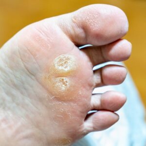 大船　巻き爪　足裏