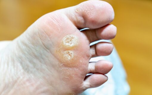 大船　巻き爪　足裏