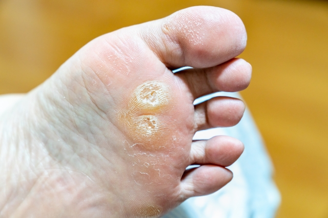 大船　巻き爪　足裏