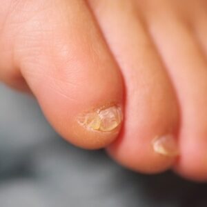 大船　巻き爪　副爪