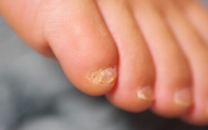 大船　巻き爪　副爪