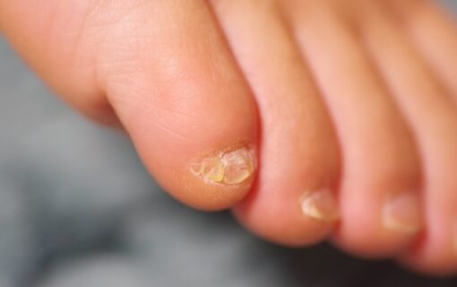 大船　巻き爪　副爪