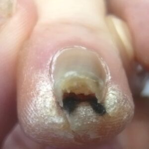 大船　巻き爪　ビフォー