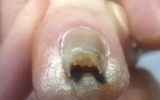 大船　巻き爪　ビフォー