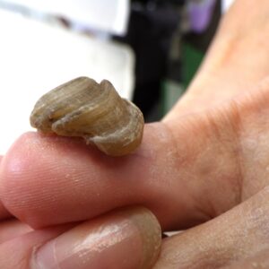 大船　巻き爪　変形爪