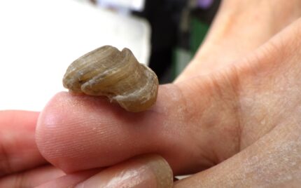 大船　巻き爪　変形爪