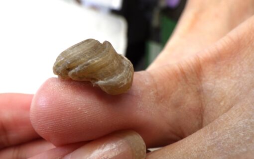 大船　巻き爪　変形爪