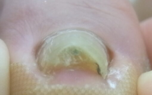 大船　巻き爪　ビフォー