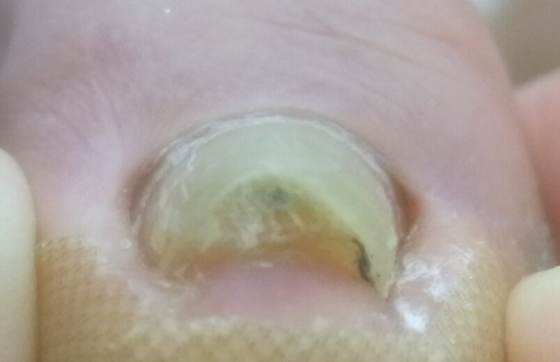 大船　巻き爪　ビフォー