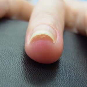 大船　巻き爪　爪