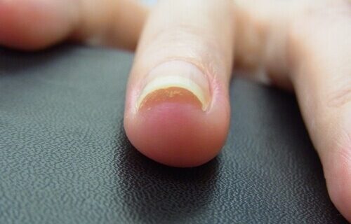 大船　巻き爪　爪