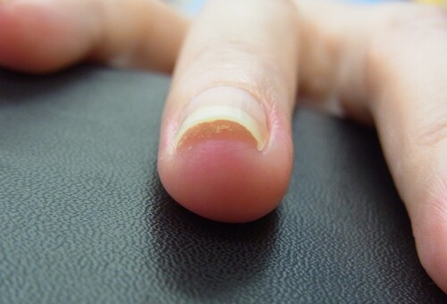 大船　巻き爪　爪