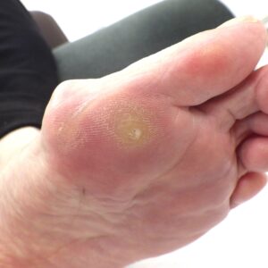 大船　巻き爪　足