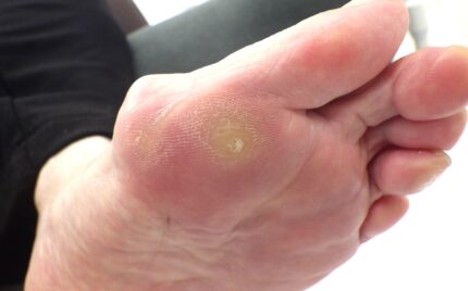 大船　巻き爪　足