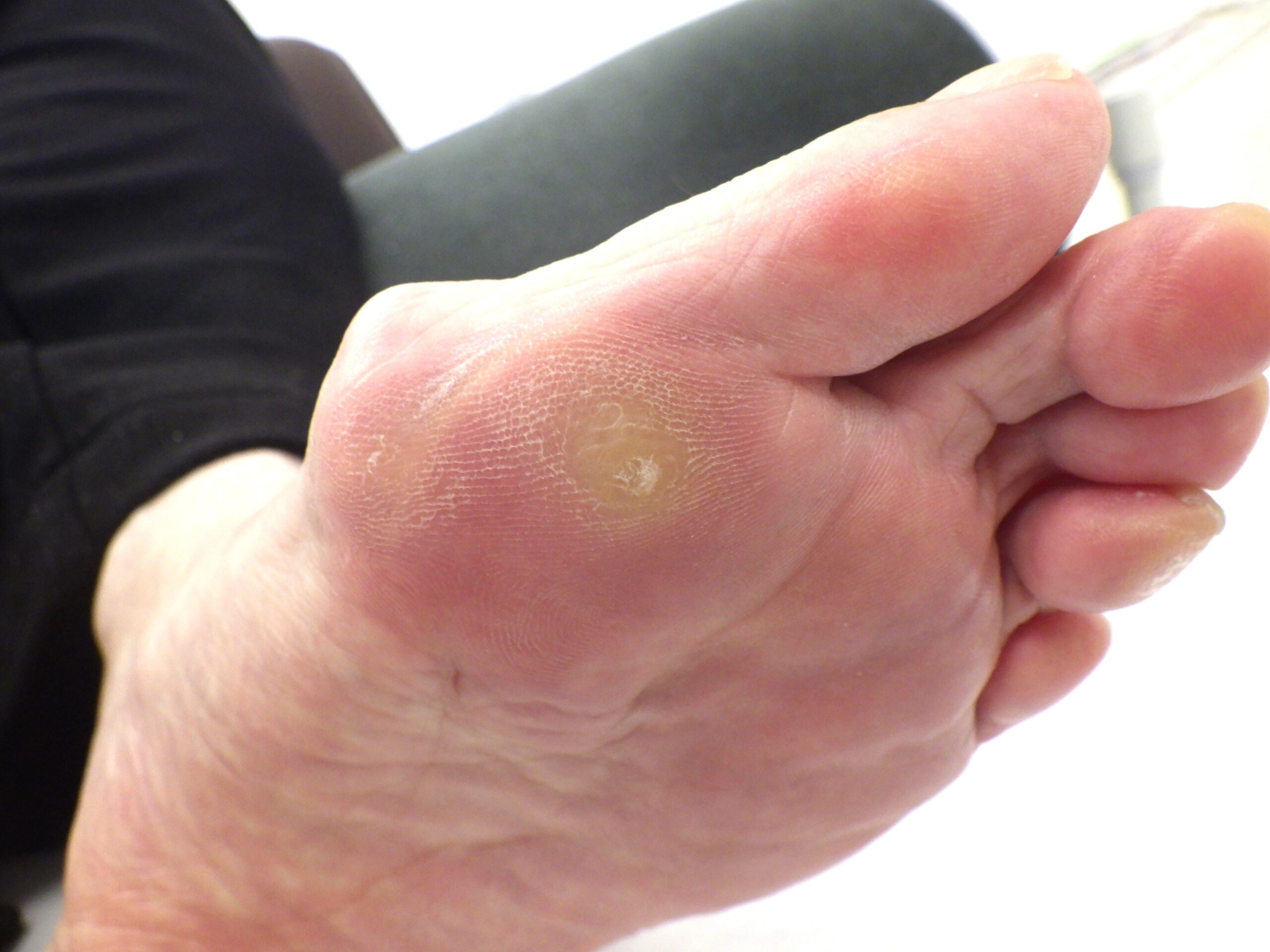 大船　巻き爪　足