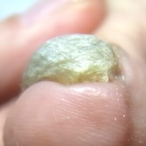 大船　巻き爪　ビフォー
