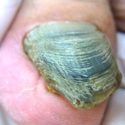 相模大野　巻き爪　変形爪