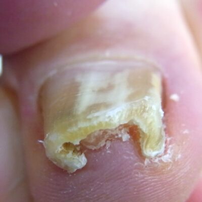 相模大野　巻き爪　ビフォー