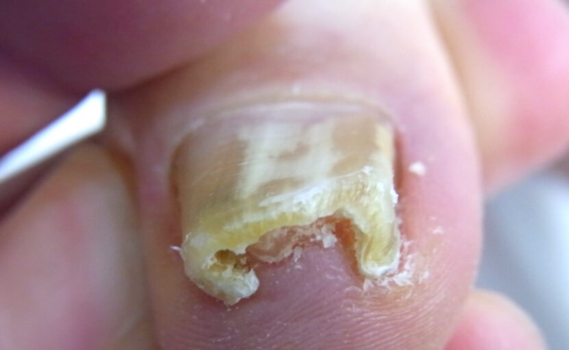 相模大野　巻き爪　ビフォー