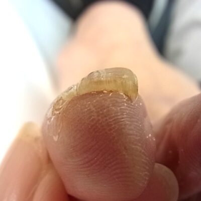 相模大野　巻き爪　肥厚爪