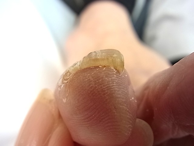 相模大野　巻き爪　肥厚爪