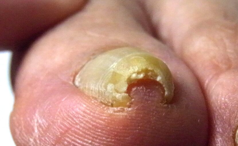 相模大野　巻き爪　ビフォー