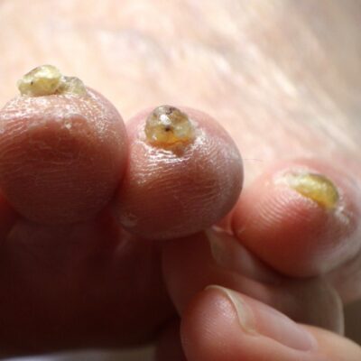 相模大野 巻き爪 ビフォー