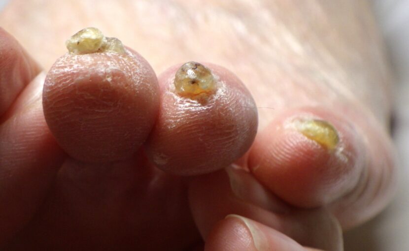 相模大野　巻き爪　ビフォー