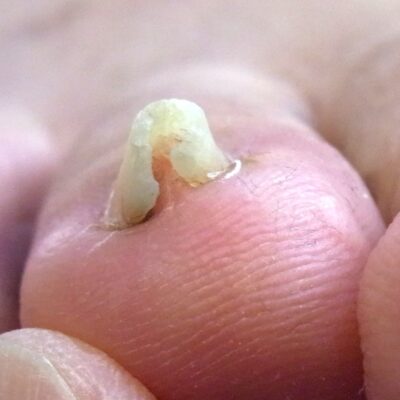 相模大野 巻き爪 ビフォー