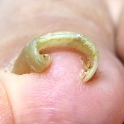 相模大野　巻き爪　ビフォー
